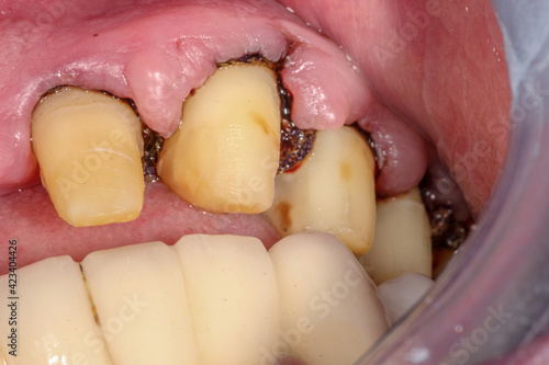 A very bad case of periodontitis