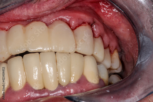A very bad case of periodontitis photo