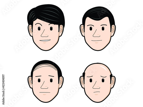 Hair loss. Graph of four stages of alopecia