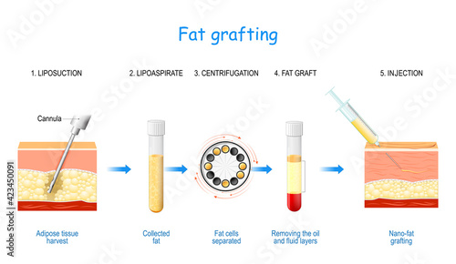 Fat grafting . Nano-fat injection