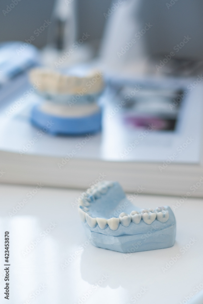 Plaster cast of the jaw in the dentist's office