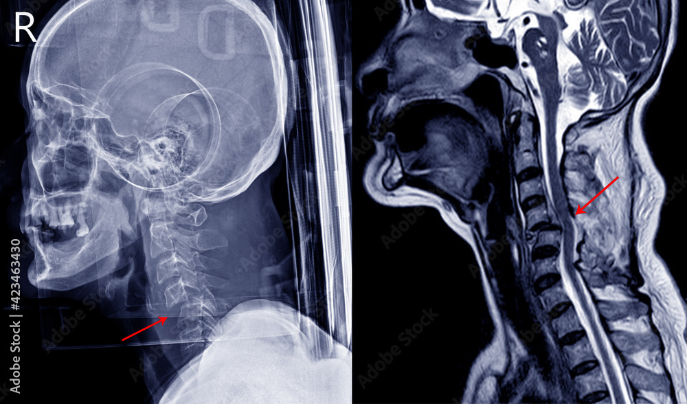 Fotka „Xray image and MRI of cervical spine case trauma showing joint