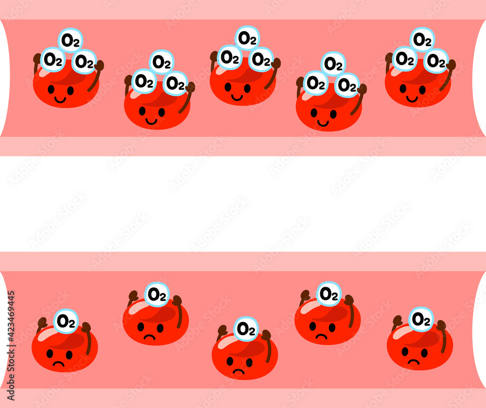 Obraz premium 酸素運搬量が減った赤血球、貧血