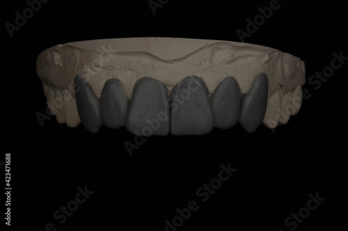 dental wax-up on black background