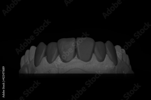 dental wax-up on black background