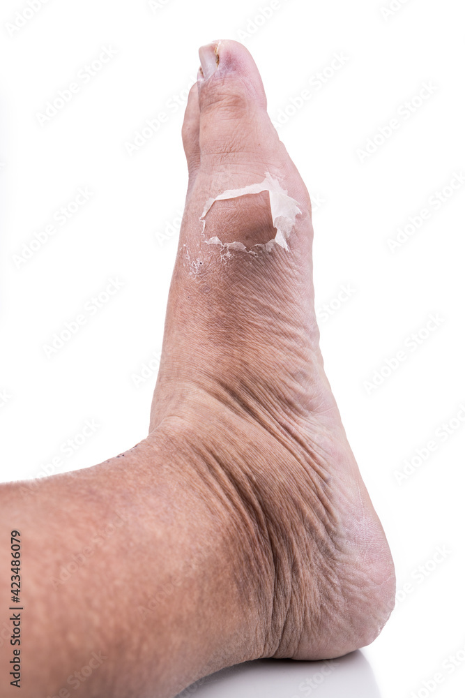 Fototapeta premium Recovered foot joint from gout attack with old skin peeling off from inflammed area.