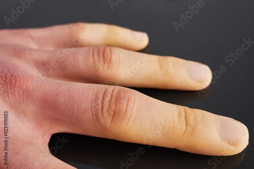 white fingers from the cold, poor blood circulation,close up