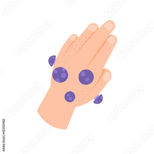 illustration of a hand affected by a fungal or skin disease. eczema or ringworm symptoms. flat style. vector design