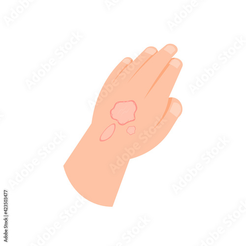 illustration of a hand affected by scurvy, ringworm, or skin disease. eczema symptoms. flat style. vector design
