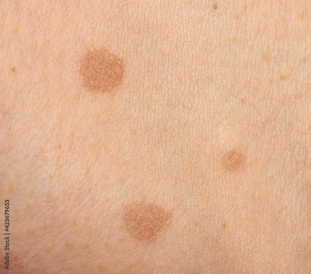 Fototapeta premium round skin burns from hot oil