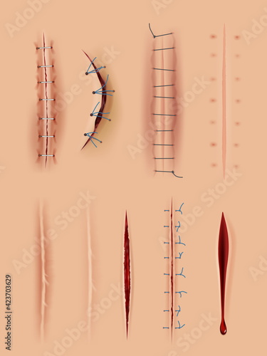 Realistic scars. Medical surgical sutures wounds close up pictures on human skin decent vector illustrations set