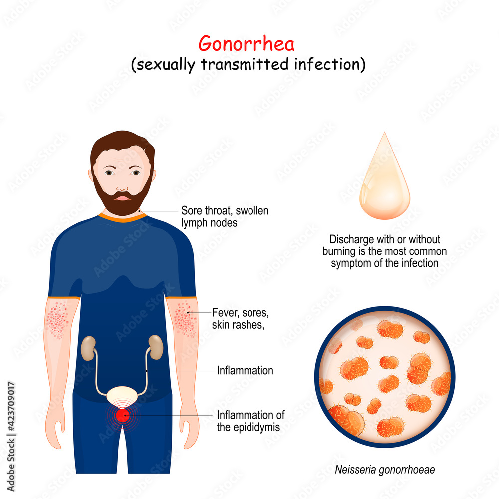 Gonorrhea. Closeuo of bacterium Neisseria gonorrhoeae Stock Vector