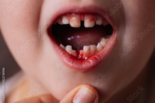Foto close-up of an open baby's mouth with bloody blisters and bleeding from the wound of a removed baby tooth on the lower jaw