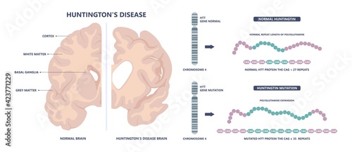 Huntington parkinson Motor alzheimer neuron brain DNA gene nerve cell juvenile problem defect genetic basal ganglia neuro repeat mutant damage testing defective mood inherits system family memory loss