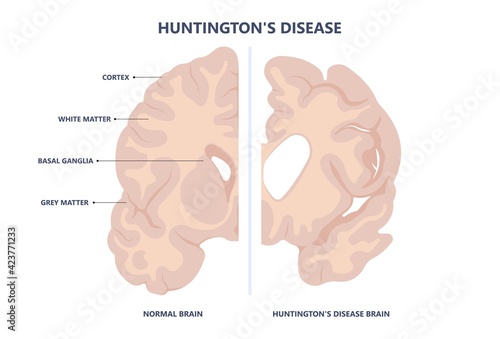 Huntington parkinson Motor alzheimer neuron brain DNA gene nerve cell juvenile problem defect genetic basal ganglia neuro repeat mutant damage testing defective mood inherits system family memory loss