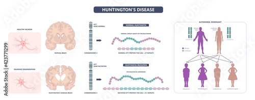 Huntington parkinson Motor alzheimer neuron brain DNA gene nerve cell juvenile problem defect genetic basal ganglia neuro repeat mutant damage testing defective mood inherits system family memory loss photo