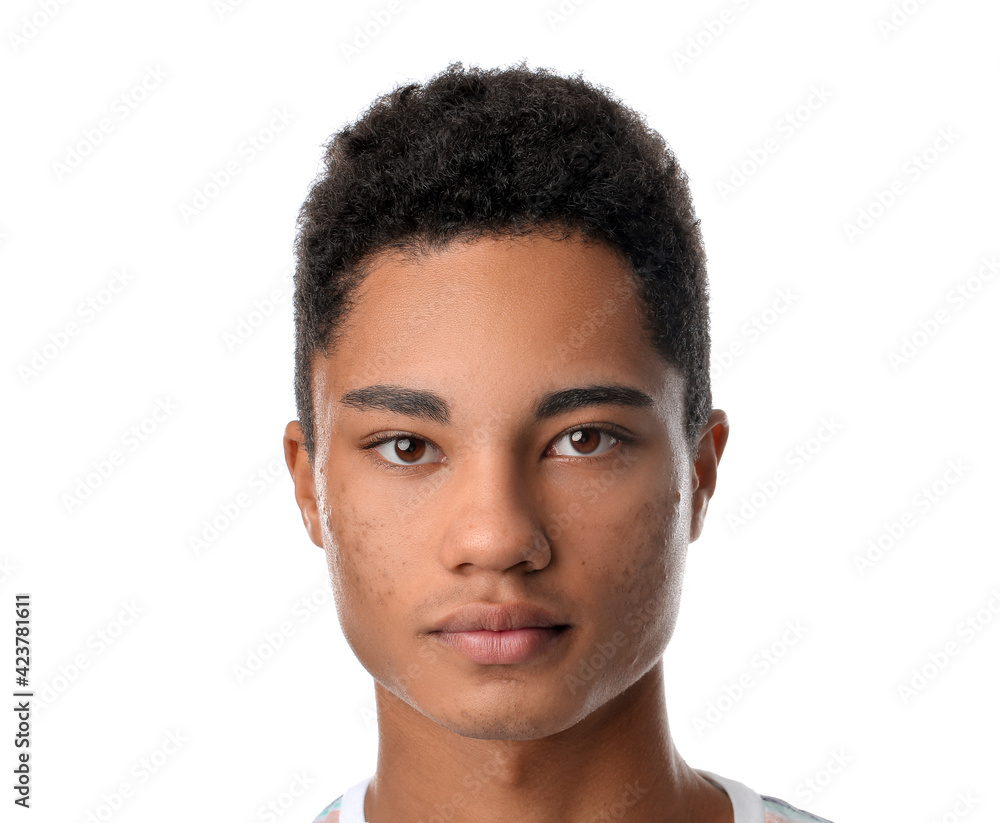 Obraz premium African-American teenage boy with acne problem on white background