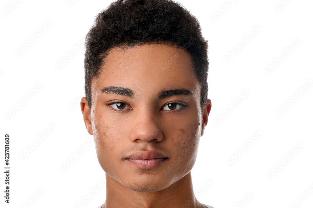 Obraz premium African-American teenage boy with acne problem on white background