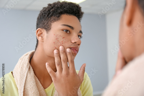 African-American teenage boy with acne problem at home photo