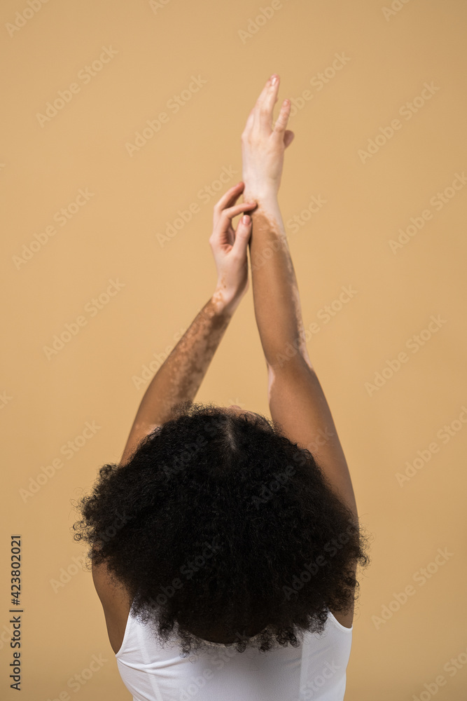 Woman with vitiligo disorder skin posing at the studio with raised hands Woman with vitiligo disorder skin posing at the studio with raised hands