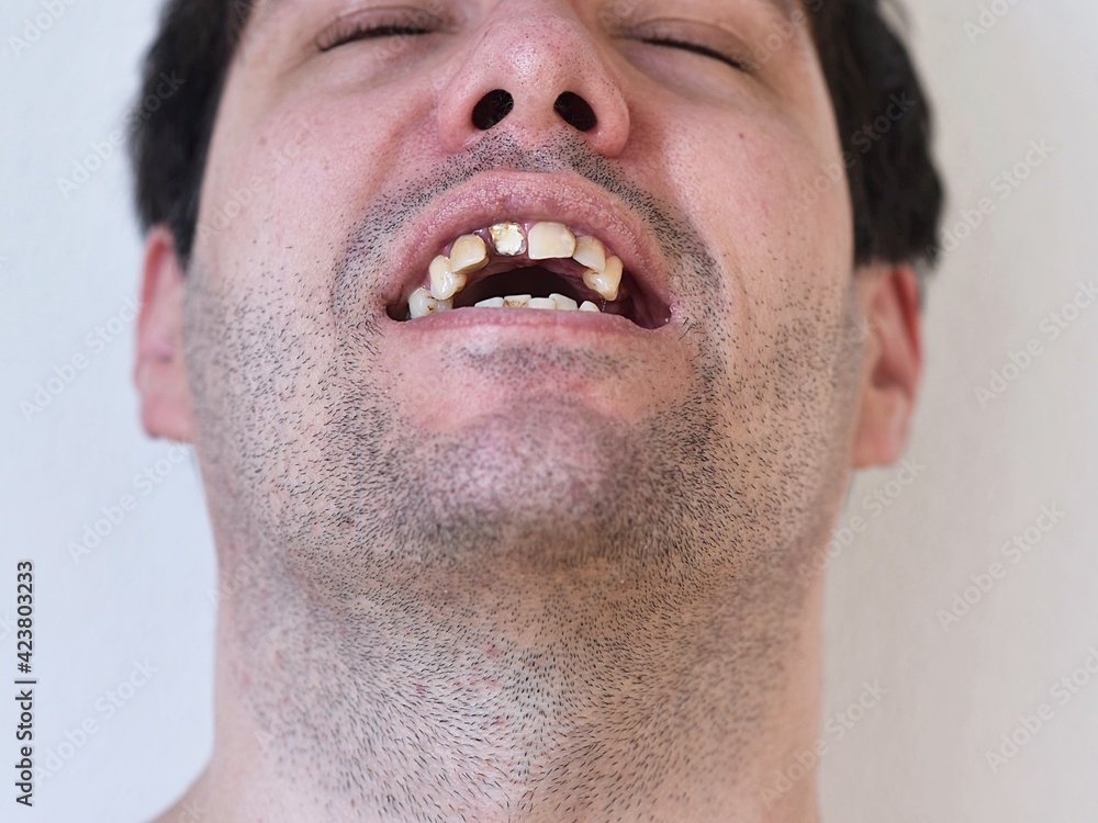 Obraz premium portrait of a man with broken teeth
