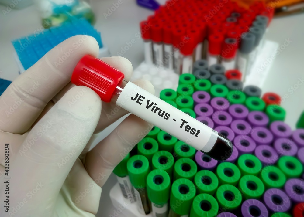 Blood sample positive with Japanese encephalitis (JE) virus, medical and health concept Blood sample positive with Japanese encephalitis (JE) virus, medical and health concept