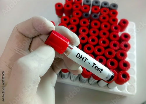 Test tube with blood sample for dihydrotestosterone or DHT hormone test photo