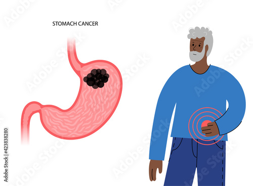 Stomach cancer concept