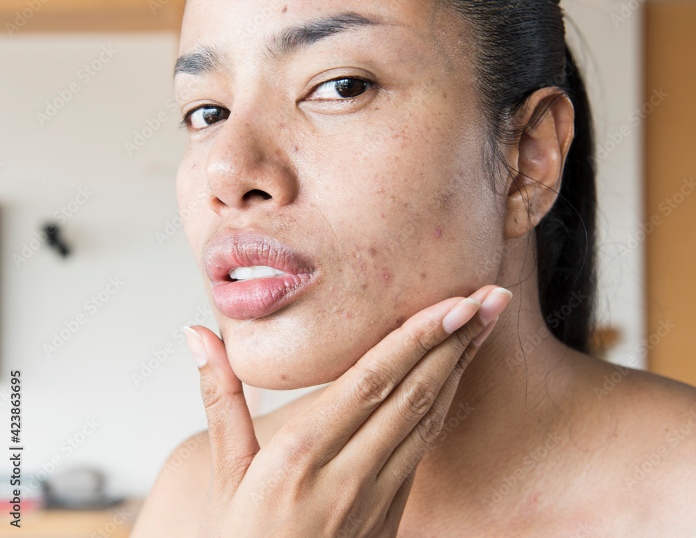 woman worry her acne. Woman skin care concept - obrazy, fototapety, plakaty 