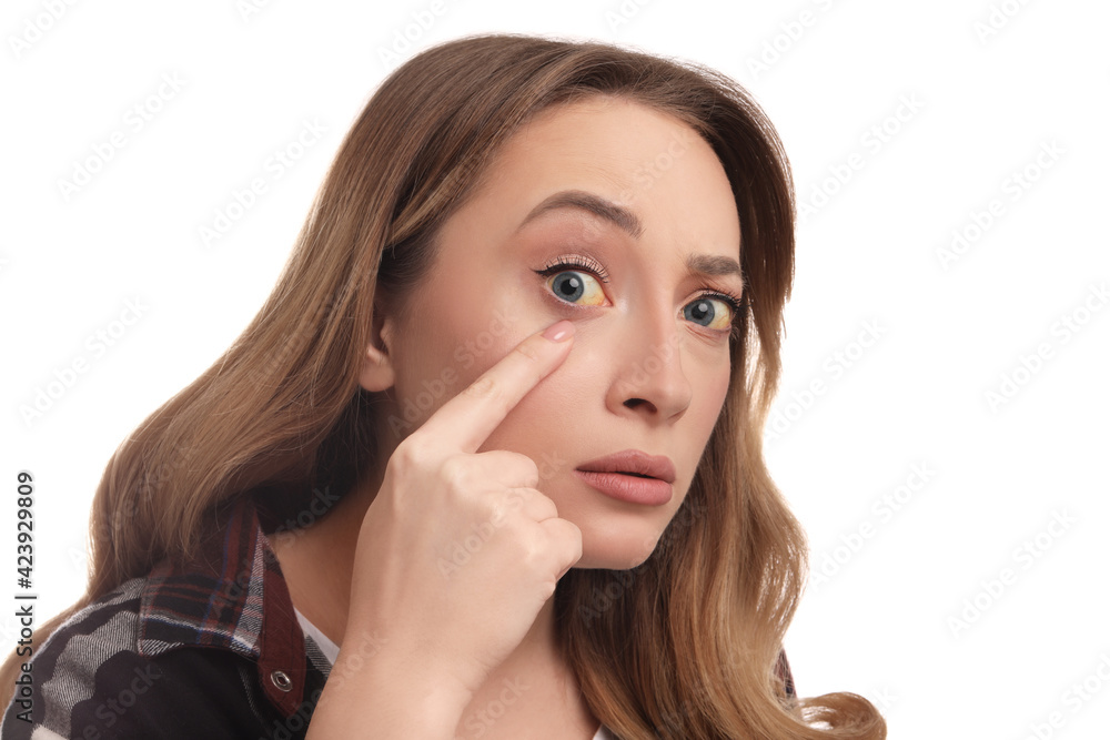 Woman with yellow eyes on white background. Liver problems symptom Woman with yellow eyes on white background. Liver problems symptom