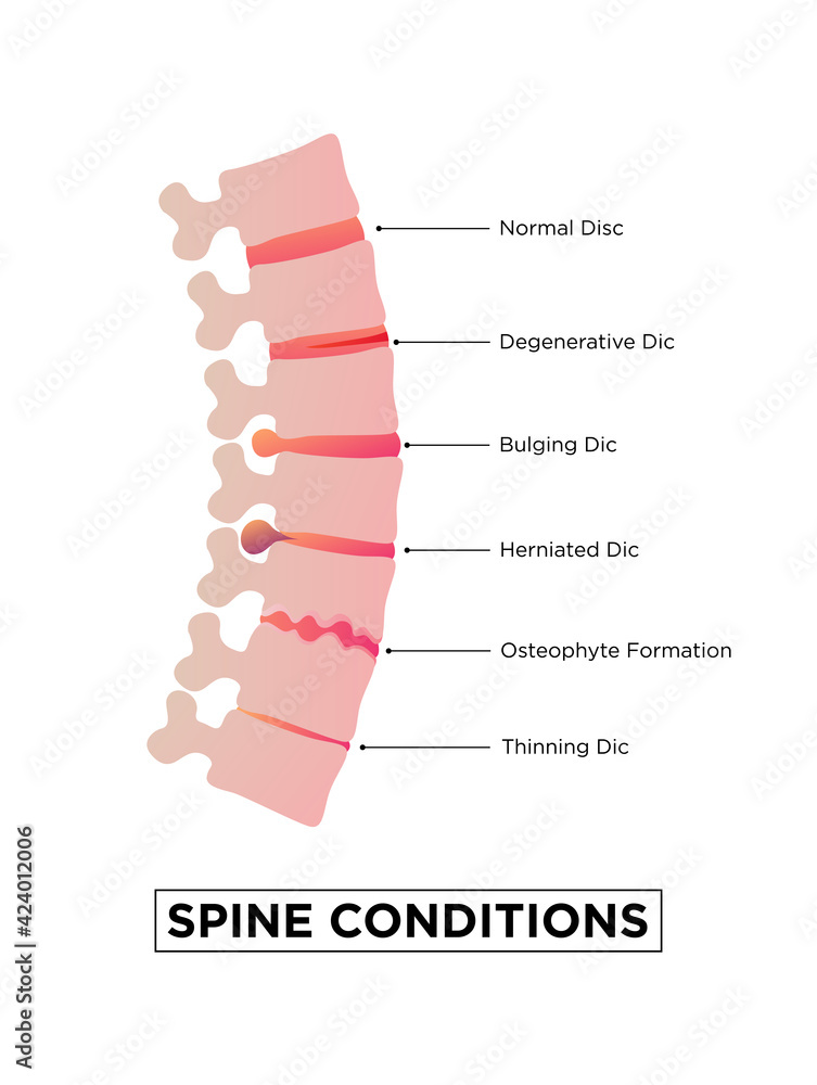 Stages of spinal Osteochondrosis. Degenerative Disc. Bulging Disc