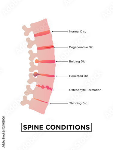 Stages of spinal Osteochondrosis. Degenerative Disc. Bulging Disc ...