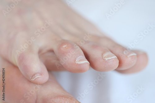 Closeup of dry callus on woman toe photo