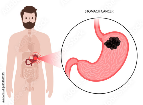 Stomach cancer concept