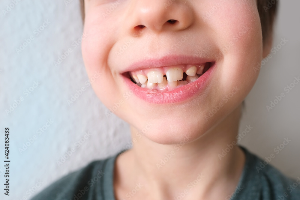 Obraz premium small child, kid 7-8 years old sits with open mouth, teeth close-up, examination of molar by a dentist, concept of dental treatment, bite checkeatment, bite check