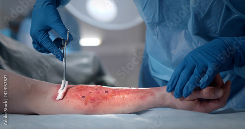 Surgeons team working with burn wound on arm of patient in operating room. photo