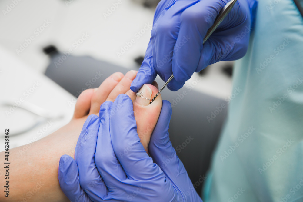 
Nail clip. A podiatrist treats an ingrown toenail. Medical pedicure procedure. Orthonyx Bracket - obrazy, fototapety, plakaty 