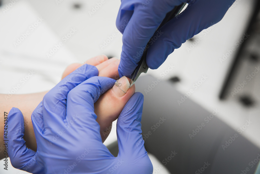 Foto Professional pedicure using a corrective brace