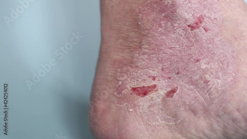 Psoriasis. Scratched area of the foot, affected by psoriatic plaques photo