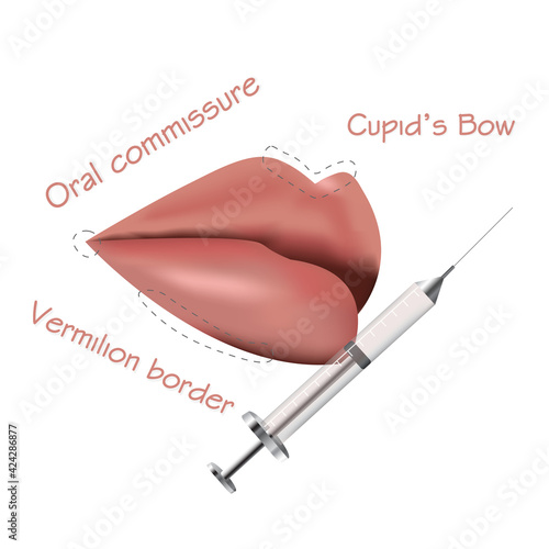 Beauty injection in lips. Big lips with anatomical zones Plastic and aesthetic surgery. Medical treatment and spa concept. Hyaluronic acid syringe. Isolated  vector illustration. lip augmentation.