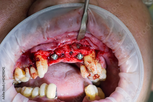 Surgery operation to install four dental implants on the upper jaw. Dental care and treatment. Teeth problems.