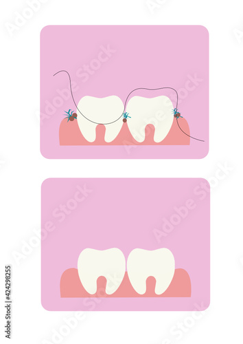 Vector illustration of teeth on a pink background. Flossing your teeth. Proper dental care. Leftover food between teeth. Oral hygiene. Dentistry.