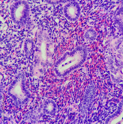 Photo of atypical endometrial hyperplasia (left side), compared to benign gland (right side),  magnification 400x, photo under microscope photo