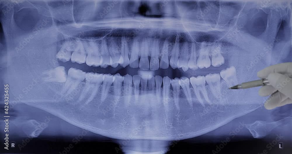 Dentist checking dental x-ray. Dental panoramic radiography

