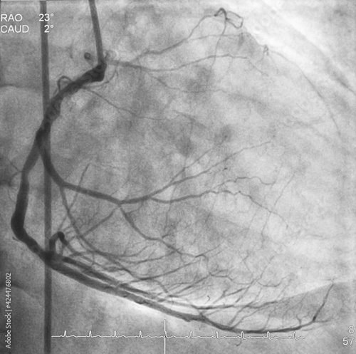 Coronary angiogram (CAG) was performed right coronary artery (RCA) stenosis. photo
