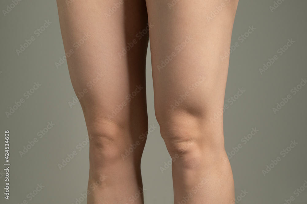 Fototapeta premium Fat folds above knees. Woman`s hips closeup raw studio shot in grey background. Dieting and fat loss concept.