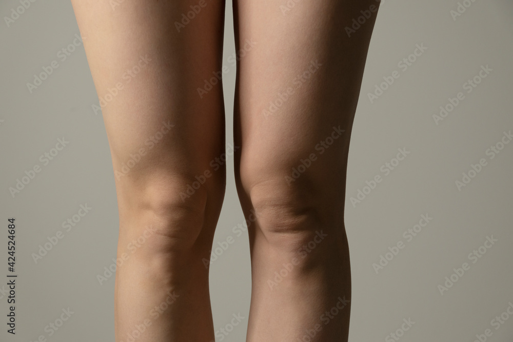 Fototapeta premium Overweight knees, contrast lightning. Woman`s hips closeup raw studio shot in grey background. Dieting and fat loss concept.
