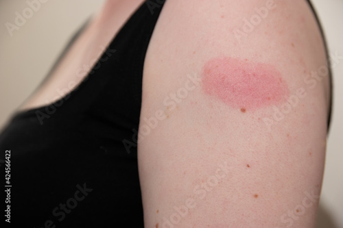 Arm of white woman 48 hours after receiving covid-19 coronovirus vaccination, showing swollen red reaction at the injection site
