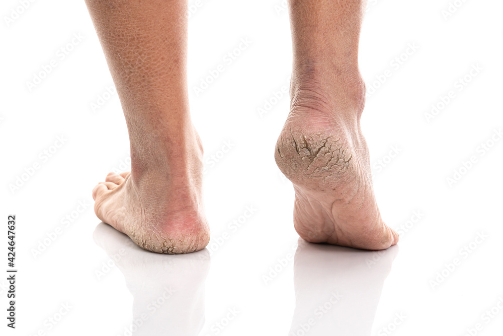 Close up of Cracks on Heels isolated white background Close up of Cracks on Heels isolated white background