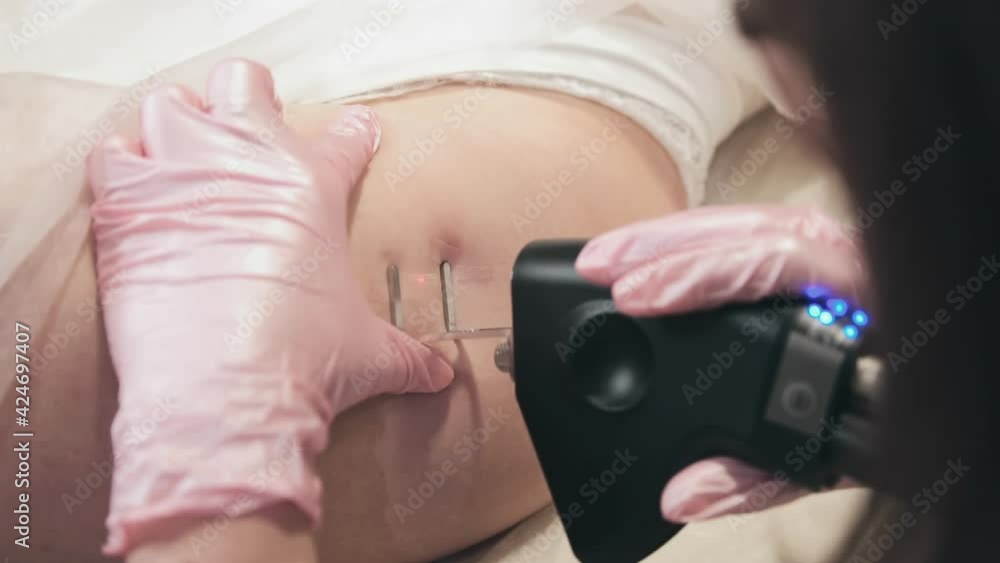 CO2 laser cosmetology, skin resurfacing CO2 laser cosmetology, skin resurfacing